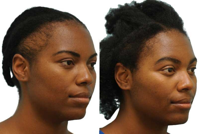 Afro Hair Transplant