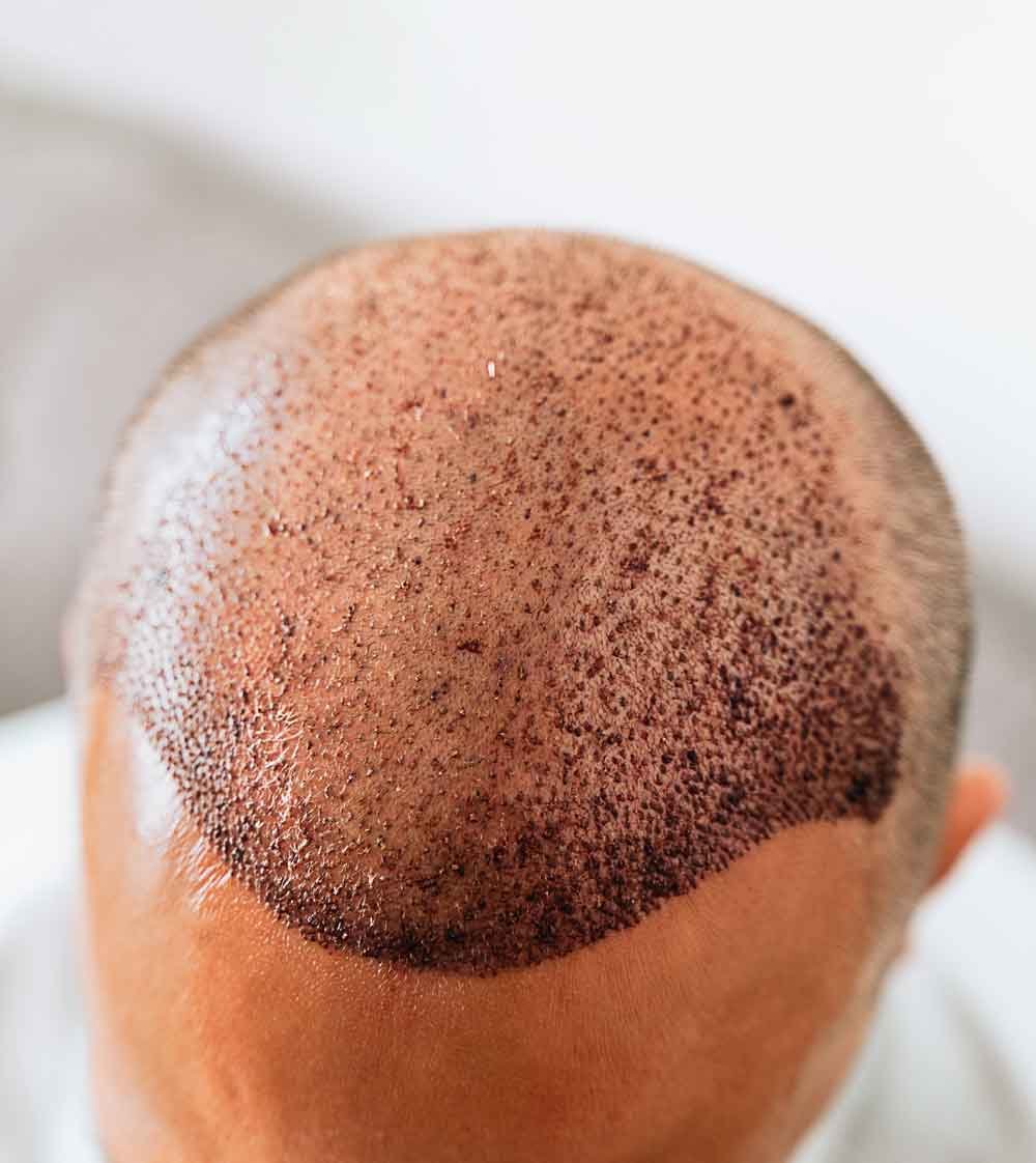 Unshaven Hair Transplant