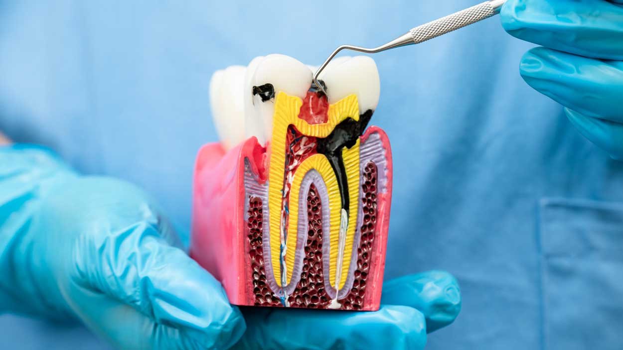 Root Canal Treatment