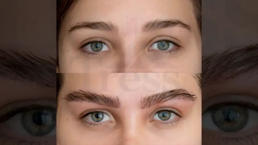 Eyebrow Transplant in Istanbul