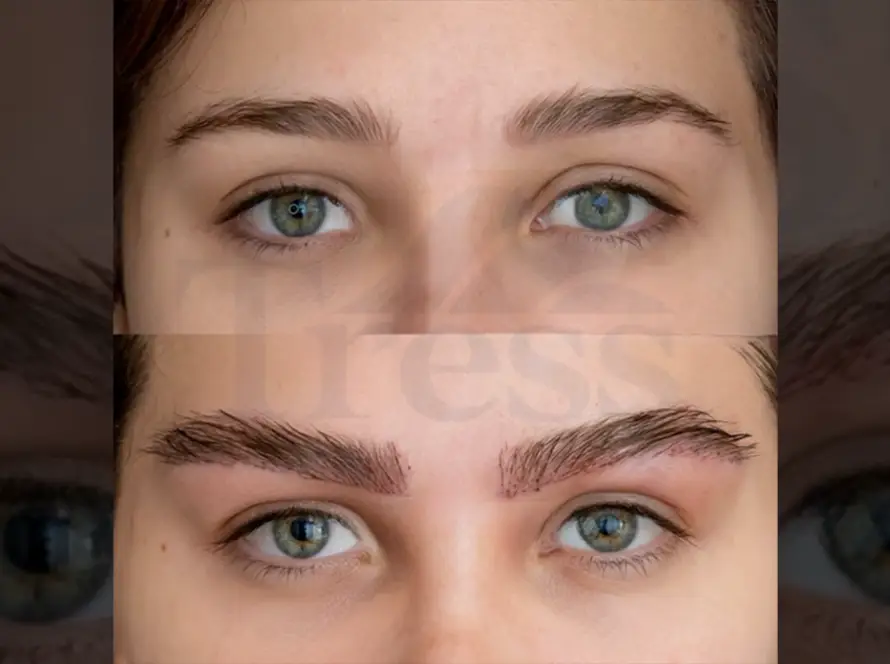 Eyebrow Transplant in Istanbul