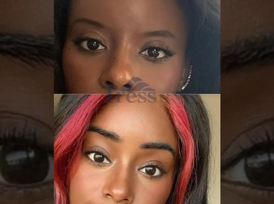 Eyebrow Transplant What to Expect