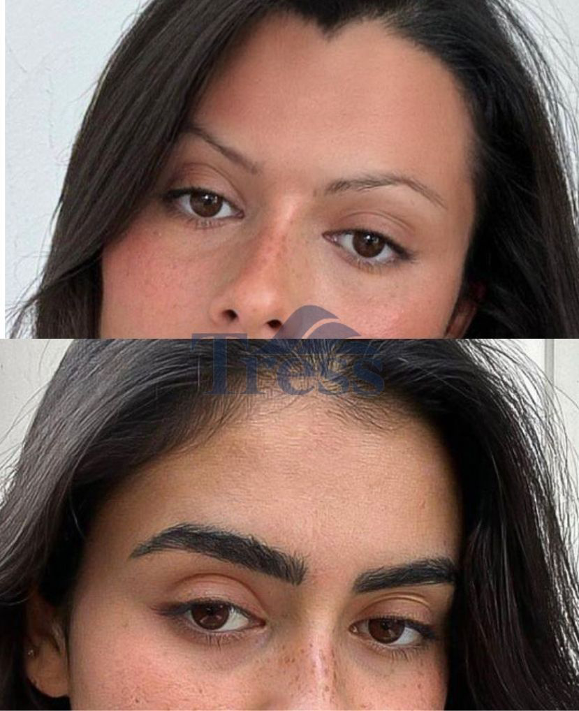 Eyebrow Transplant What to Expect