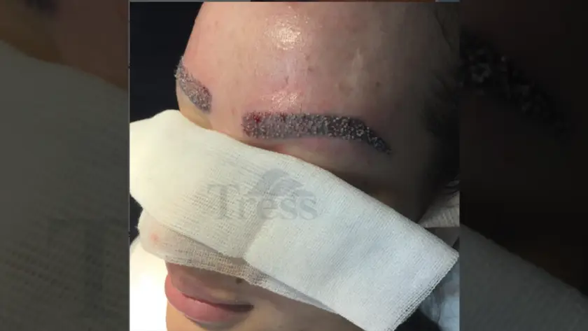 Do Eyebrow Transplants Keep Growing?