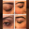 Eyebrow Transplant Clinic