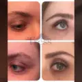 How Long Do Eyebrow Transplants Last?