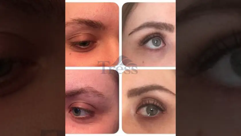 How Long Do Eyebrow Transplants Last?