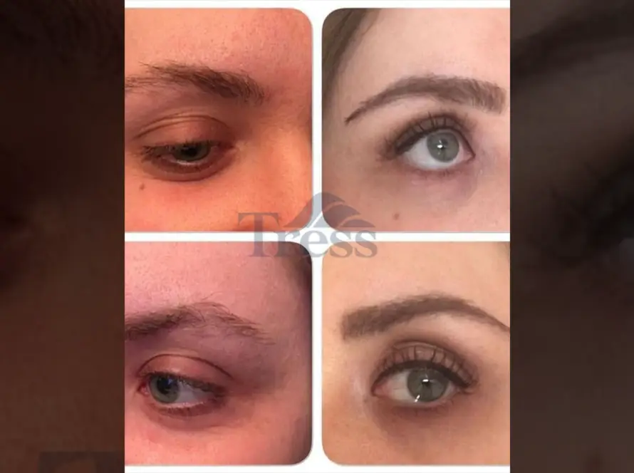 How Long Do Eyebrow Transplants Last?