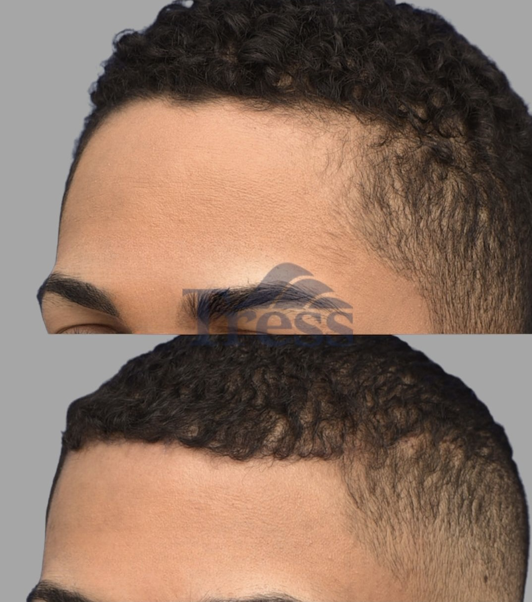 Forehead Reduction