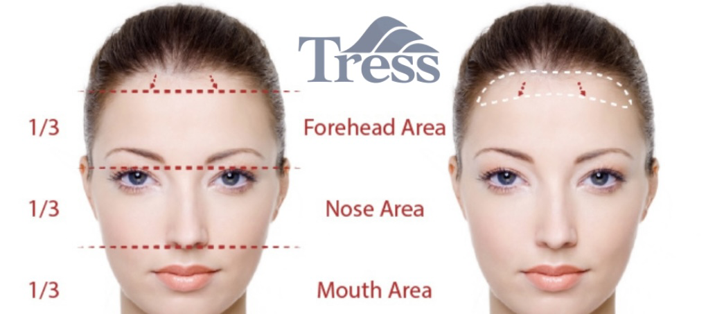 Forehead Reduction