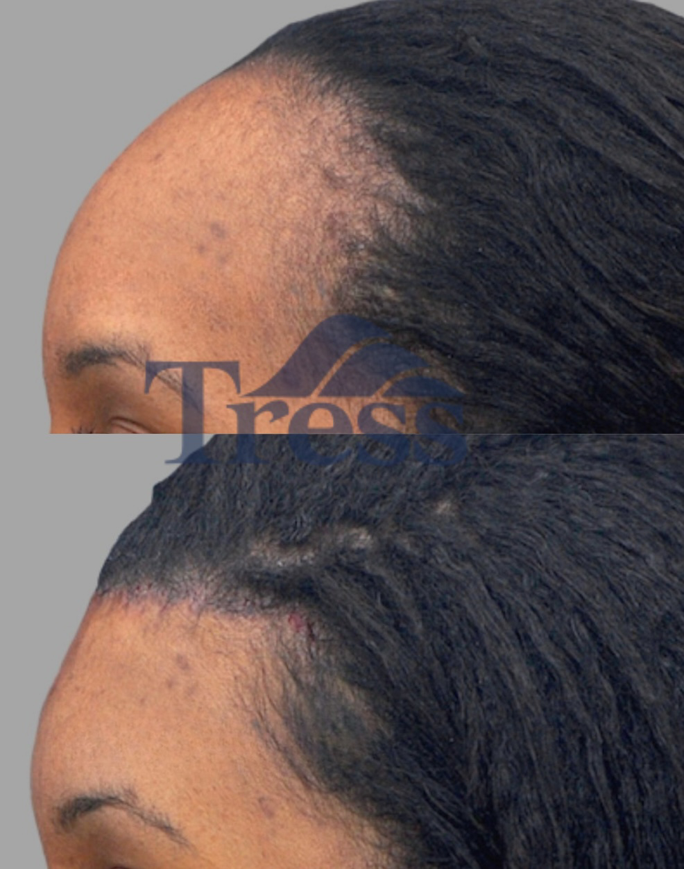 Forehead Reduction