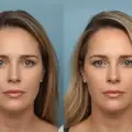 Forehead Reduction Surgery