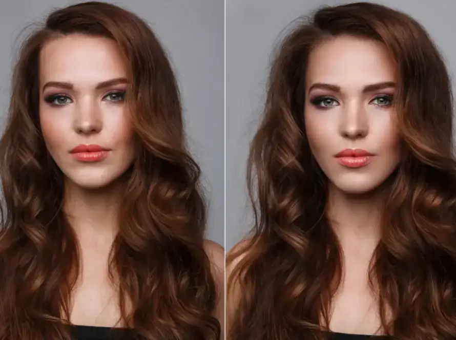 tress clinic forehead reduction surgery before and after