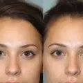 Forehead Reduction Surgery Procedure