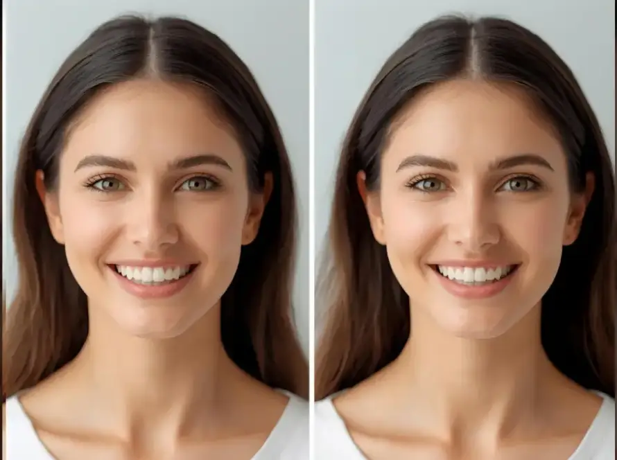 forehead_reduction_surgery